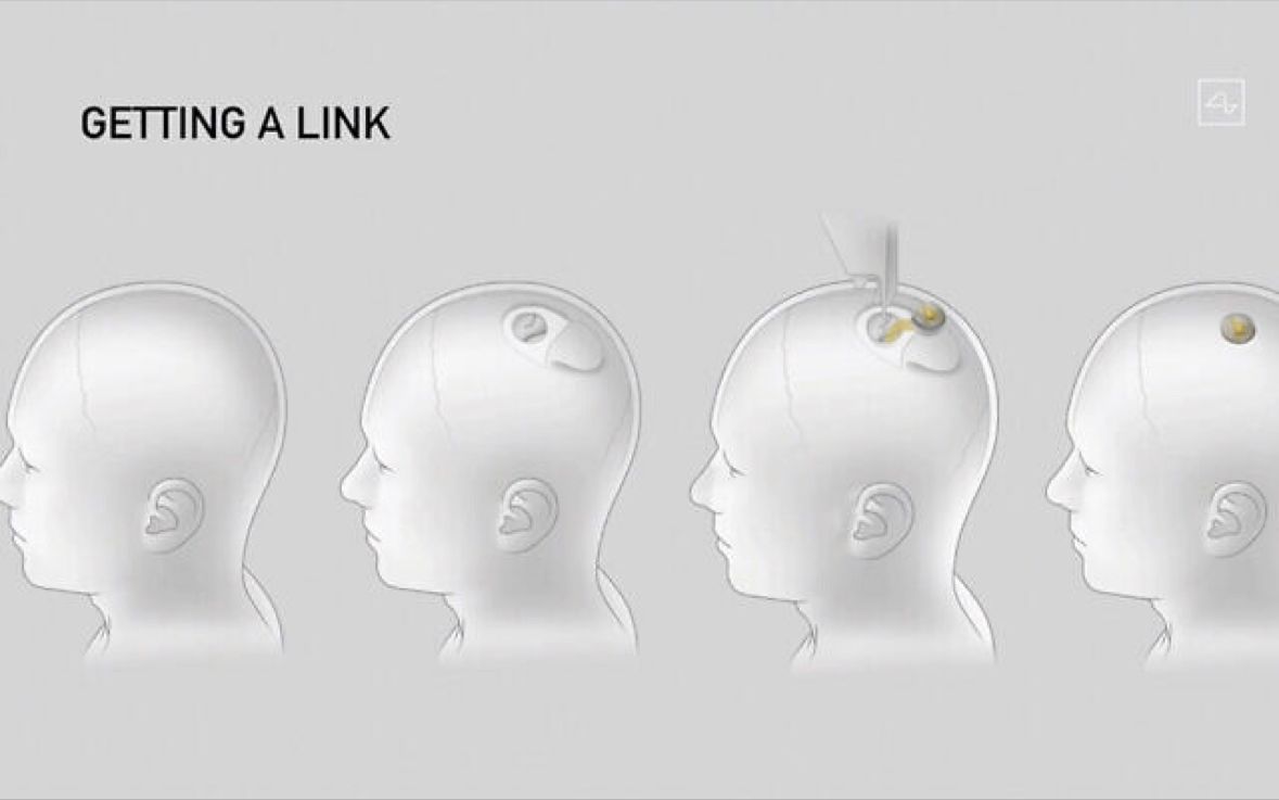 Original post media: Alon Musk’s Neuralink Startup started recruiting volunteers to test brain implants.